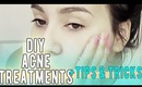 DIY ACNE HOME REMEDIES / TREATMENTS , TIPS , AND TRICKS!