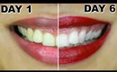 How To Whiten Teeth At Home | HiSmile Review | ShrutiArjunAnand