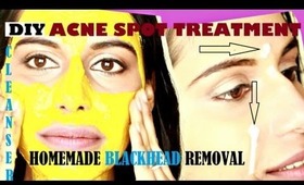 DIY ACNE TREATMENT & BLACKHEAD REMOVAL with Spot Treatment + Deep Cleanser at home (home remedies)