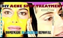 DIY ACNE TREATMENT & BLACKHEAD REMOVAL with Spot Treatment + Deep Cleanser at home (home remedies)