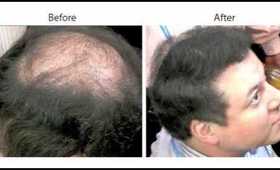 Hair Loss Remedies