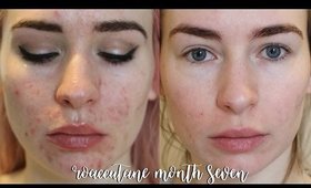 ROACCUTANE MONTH 7! Update + Side Effects