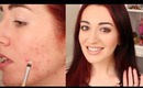 How To Cover A Pimple & Mild Acne Scarring | Makeup Tutorial For Acne