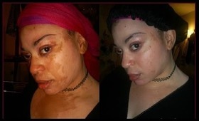 *****MY VITILIGO UPDATE*****