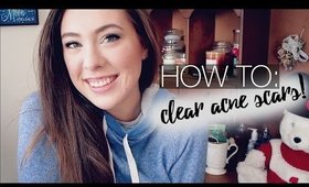 How To: Get Rid of Acne Scars // Quick, Easy, + Cheap