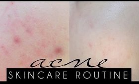 ACNE SKINCARE ROUTINE | Updated Skincare Sensitive Acne Prone Skin