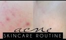 ACNE SKINCARE ROUTINE | Updated Skincare Sensitive Acne Prone Skin