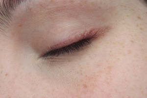 Beware of eyeliners with ingredients you are allergic to!
It hurts!!! =/