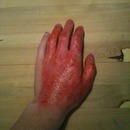 burnt hand