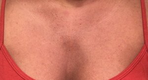 Small Oily Bumps On Chest