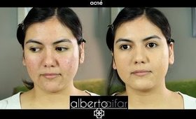 Maquillaje para cubrir acné