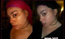 ****MY VITILIGO UPDATE*****