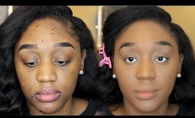 Updated Foundation Routine | How to Conceal Acne Scars | 2016