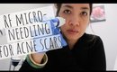 HOW I CURED MY ACNE SCARS | WHAT IS RADIOFREQUENCY MICRONEEDLING |Thefabzilla