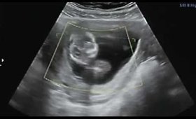13 Week Ultrasound I  Classic Turner Syndrome | Hydrops + Cystic Hygroma