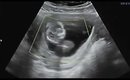13 Week Ultrasound I  Classic Turner Syndrome | Hydrops + Cystic Hygroma
