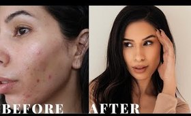 HOW TO REALLY GET RID OF ACNE OVERNIGHT