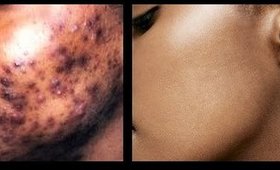 How to Remove Dark Spots & Black Spots on Face - Flawless Glowing Skin!