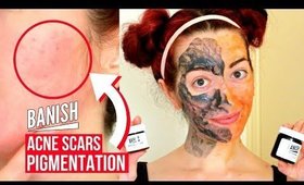 BANISH ACNE SCARS: Review & TEST | Pumpkin Enzyme Mask VS Activated Charcoal Mask