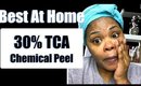 Best At Home Chemical Peel Process For Acne Scars 2019
