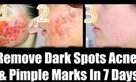 Remove Dark Spots Acne Scars & Pimple Marks In 7 Days| SuperPrincessjo