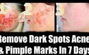 Remove Dark Spots Acne Scars & Pimple Marks In 7 Days| SuperPrincessjo