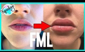 I Got Lip Fillers to Get Rid of my Dry Chapped Lips- Worth the $$$?? [Before and After + VLOG]