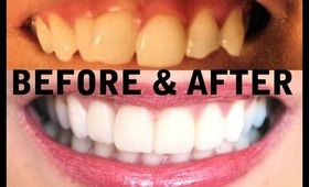 My TEETH (Before & After) Invisalign, Zoom Whitening, Veneers - AprilAthena7