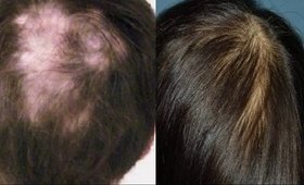 How To Stop Hair Fall? _  Grow Hair Faster at Home/ Prevent Hair Thinning | SuperWowStyle