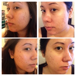 My acne scar progress after 2 weeks of using Paula's choice 2% BHA exfoliator every day 