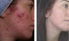 ✔ UPDATED Exposed Skin Care Review - 1 Year on! My Acne "CURE"