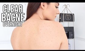 How To Get Rid Of BACK ACNE OVERNIGHT !!
