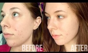 How I Cleared Up My Acne!