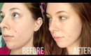 How I Cleared Up My Acne!