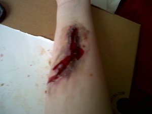 arm wound