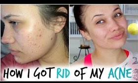 HOW I GOT RID OF MY ACNE