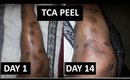 TCA Peel | Fading Surgery Scars | Weeks 1-2 | Demo + Result Pics
