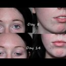 Week 2 Update - Clinique Anti Blemish Solutions 