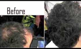 Hair Loss Treatment with Caboki Hair Fiber