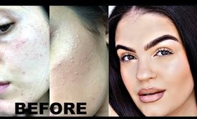 How to Get Rid of Textured Skin | Keratosis Pilaris, Acne, Milia