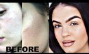 How to Get Rid of Textured Skin | Keratosis Pilaris, Acne, Milia