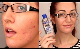 REDUCE REDNESS FROM PIMPLES FAST! My Top 3 Tips! *REQUESTED!*