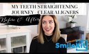MY CLEAR ALIGNERS JOURNEY - STRAIGHTENING MY TEETH BEFORE AND AFTERS WITH SMILEKIT | LISA GREGORY AD