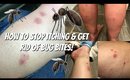 How to STOP ITCHING!!!! & GET RID of Bug Bites