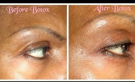 Part 9: Blepharoplasty / Upper Eyelid Surgery / Botox Injections /8 Month Post-op /
