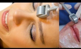 best way to get acne free skin using a derma roller + c boost from 302 skincare