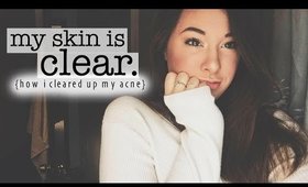 I Have No More Acne?! How I Cleared Up My Skin