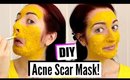 DIY Mask for ACNE & SCARRING! How To Brighten Skin With TURMERIC!