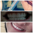 Tooth whitening 