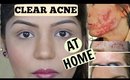 Overnight Acne Treatment & Skin Lightening Face Mask | SuperPrincessjo